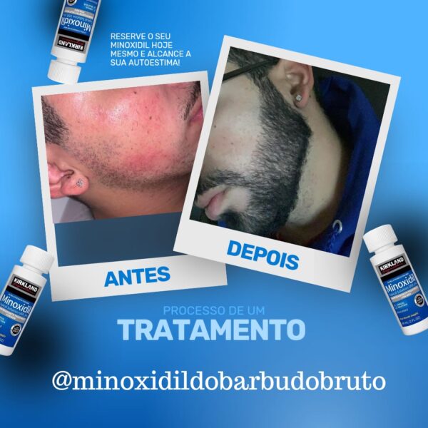 minoxidil kirkland 5% original do barbudo bruto